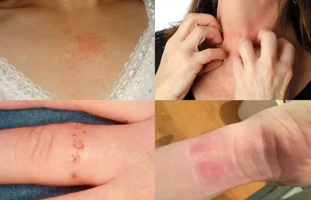 导致皮肤长水斑,起水泡,甚至伴有糜烂现象,瞬间毁容颜!