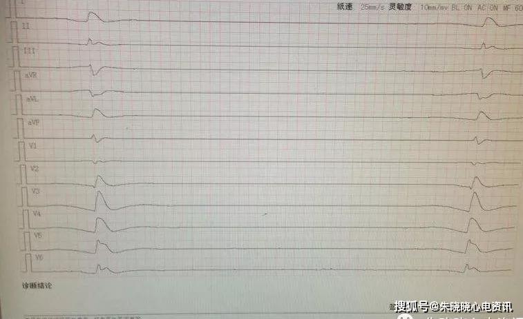 临终三种心电图及结论图片