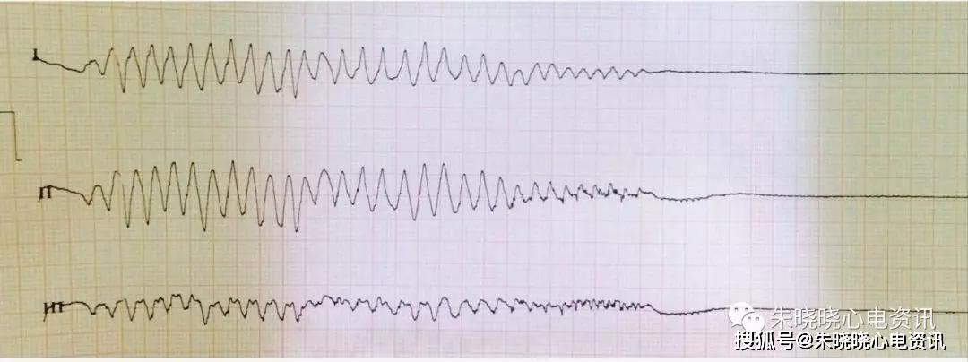 临终三种心电图及结论图片