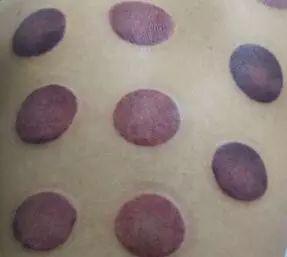 一看就会,手把手教你拔罐(拔罐大全)