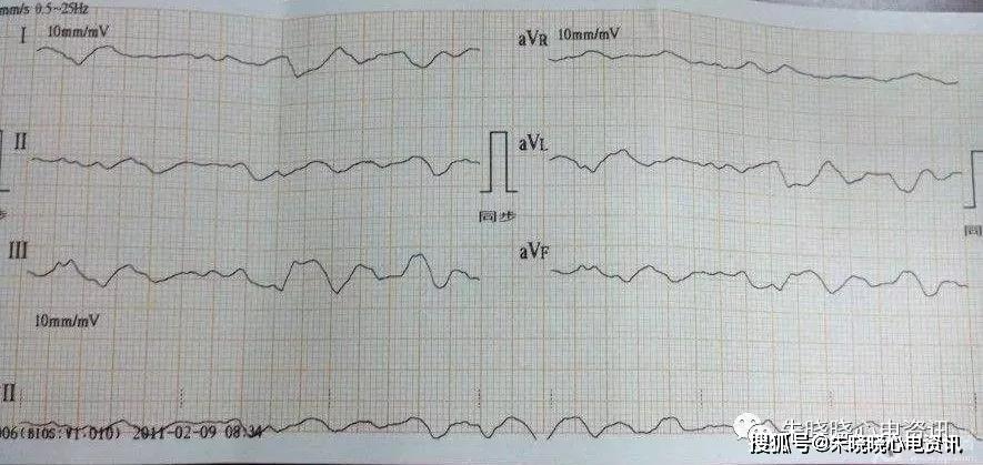 临终三种心电图及结论图片