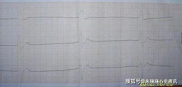 临终三种心电图及结论图片