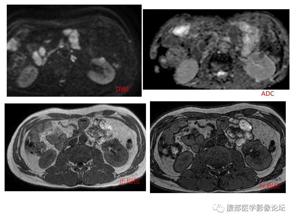 肾脏丨血管平滑肌脂肪瘤