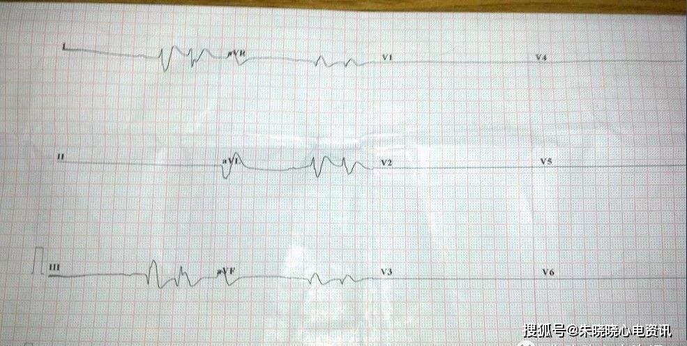 临终三种心电图及结论图片