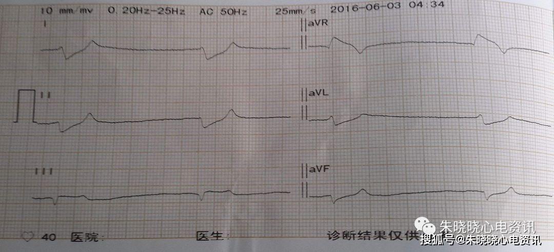 临终三种心电图及结论图片