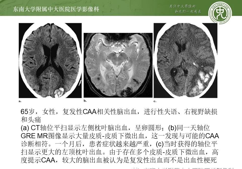 病例分享脑淀粉样血管病病例分享及概述