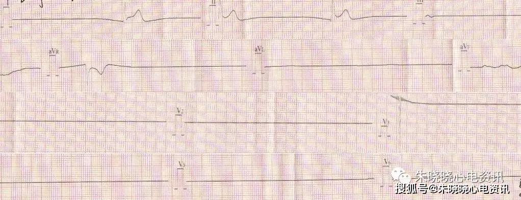 多份臨終心電圖波形