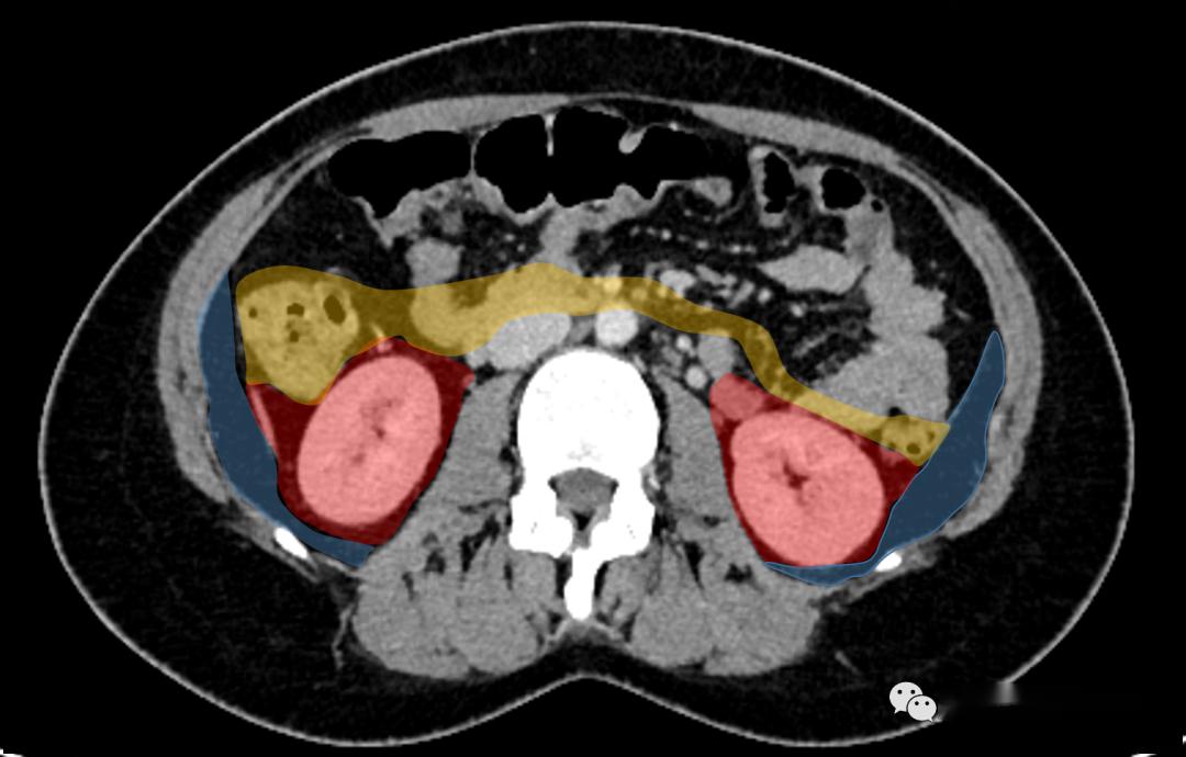 肾间隙图片