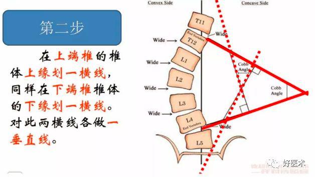 收藏 骨科常用的角度测量方法汇总,全在这里了!