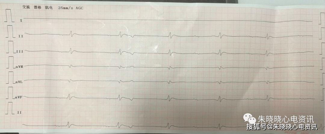 临终三种心电图及结论图片