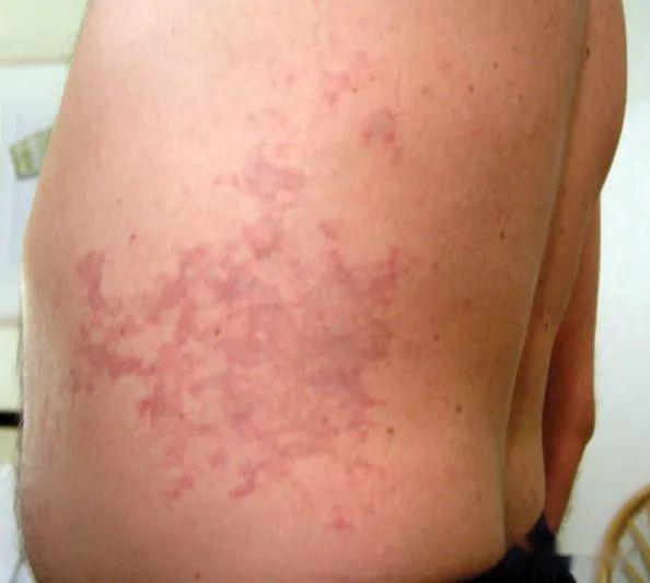 让我尝试解释下减压病?