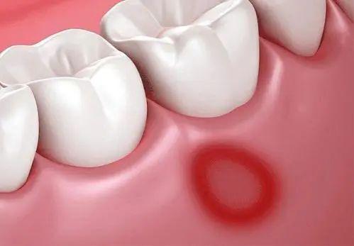 注意反复口腔溃疡可能是身体发出疾病的征兆