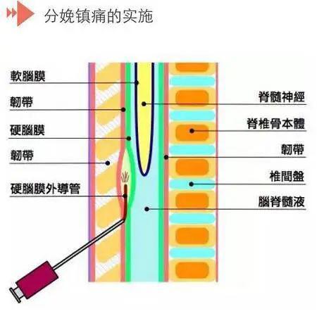 所以简言之硬膜外麻醉就是把麻醉药物打入硬膜外,起到镇痛的作用