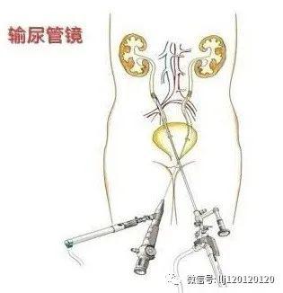 一,术后注意事项1,疼痛:输尿管镜手术没有切口,术后一般疼痛不适较轻