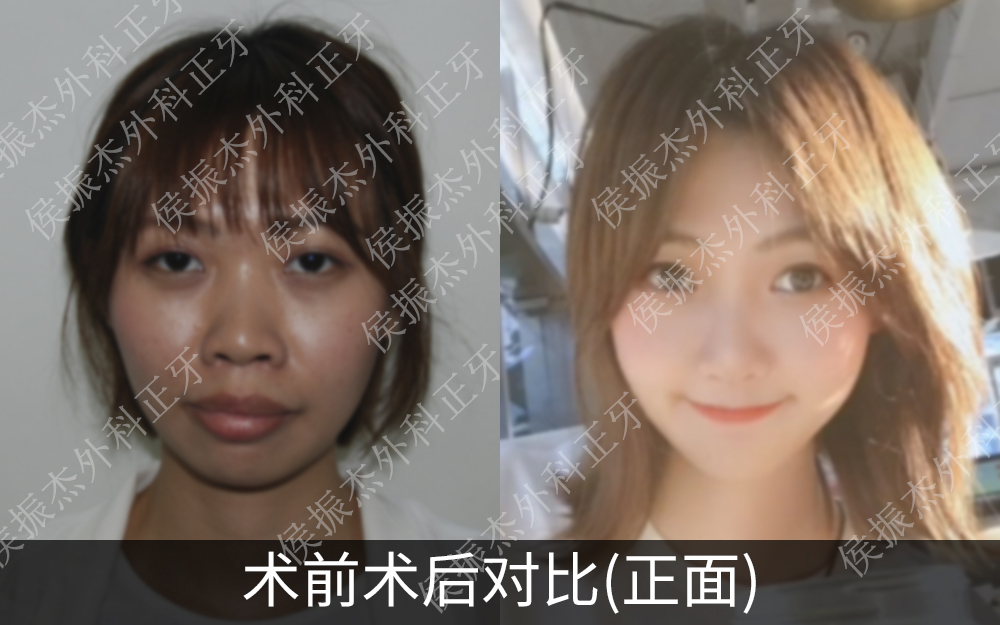 最真实龅牙矫正后脸型变化图对比