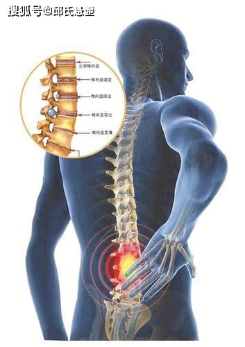 腰痛很明显,该部位在腰部,通常一侧较重,腿部疼痛多为一侧或两侧,从