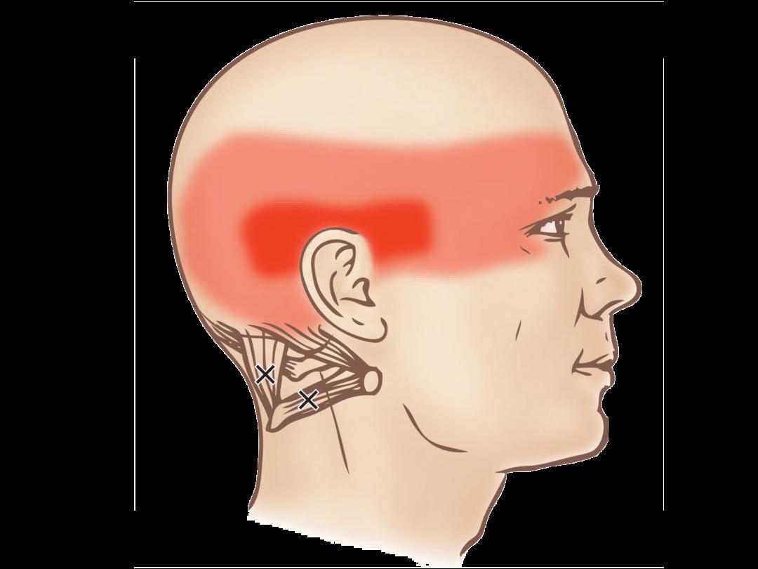 太阳穴疼痛的六块肌肉