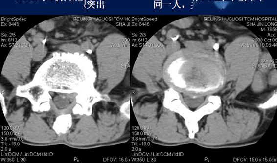 腰椎ct診斷椎間盤突出椎管狹窄退行性改變