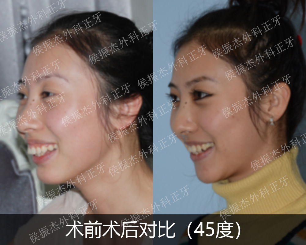 龅牙矫正后脸型变化图图片