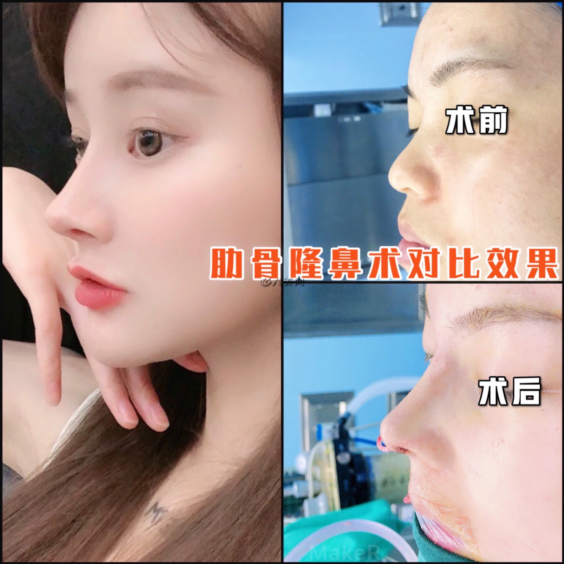 肋软骨隆鼻到底能不能做