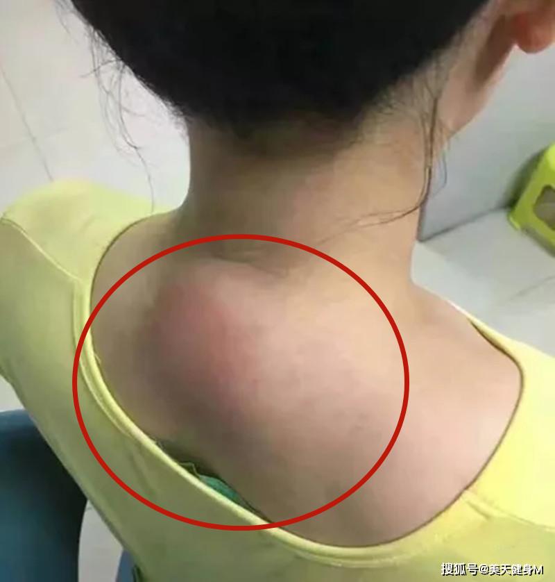 长期低头玩手机形成"富贵包",别大意,可能是你忽略了这块肌肉_颈椎