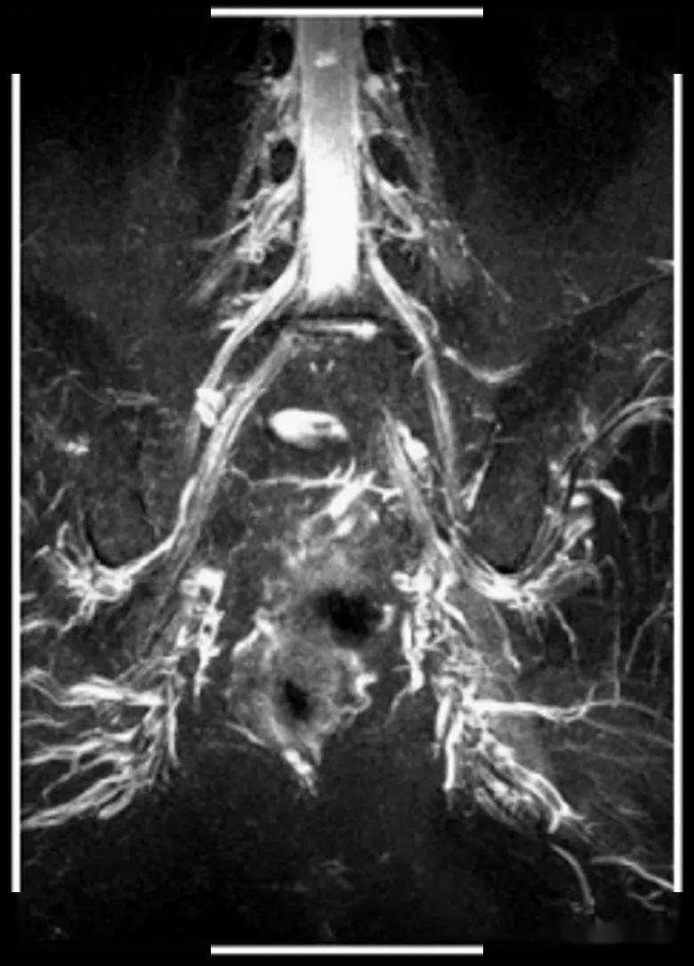 腰骶丛磁共振神经成像