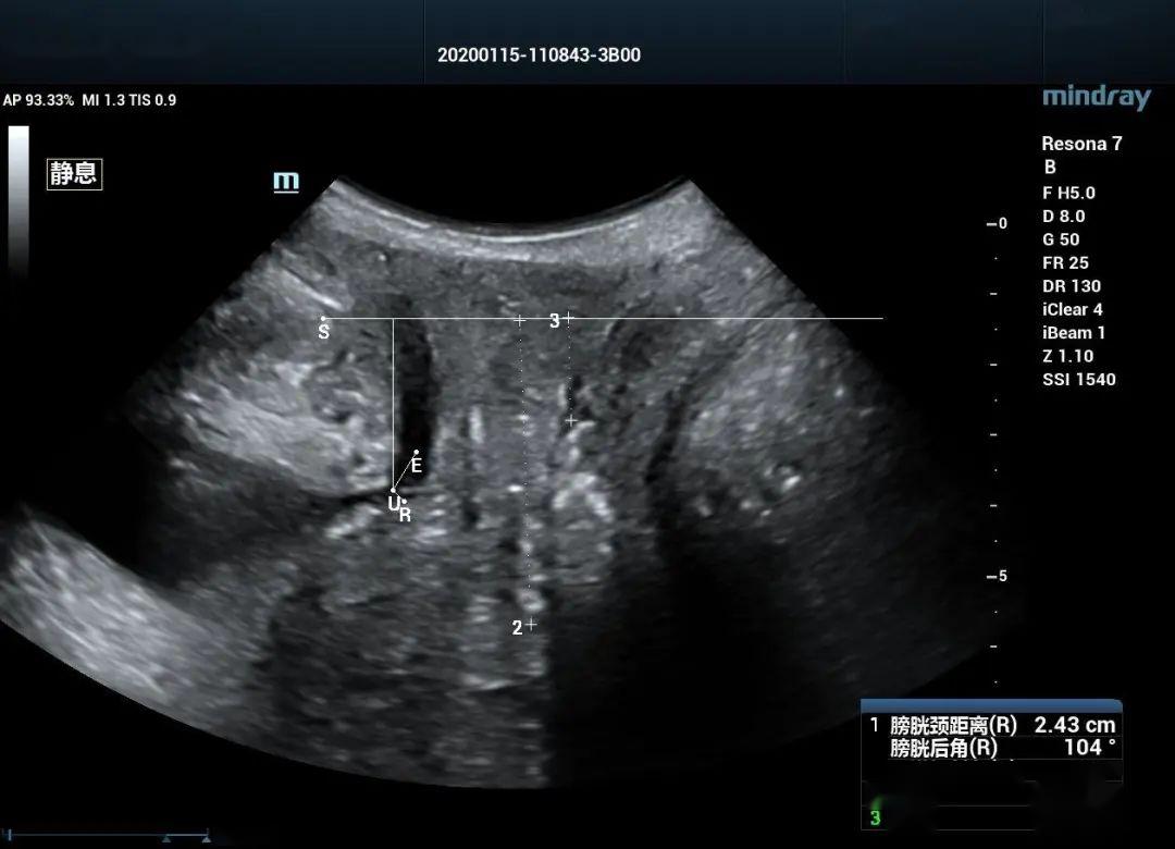 耻骨联合超声图像图片