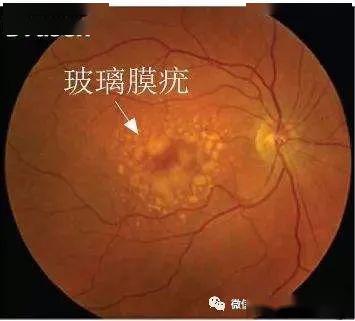 招飞体检眼科常见异常玻璃膜疣