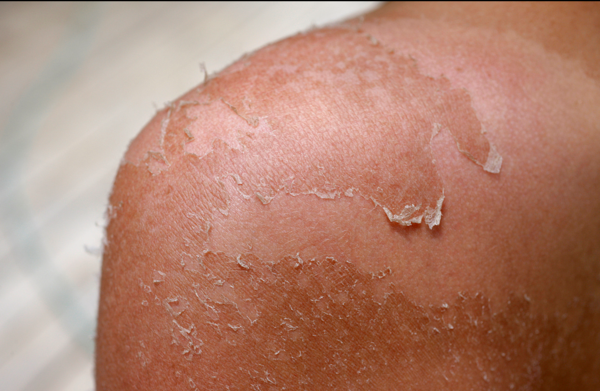 过敏怎么办?正确的晒后修护姿势看这里.