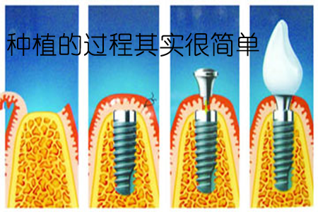 种植牙三期图解 步骤图片