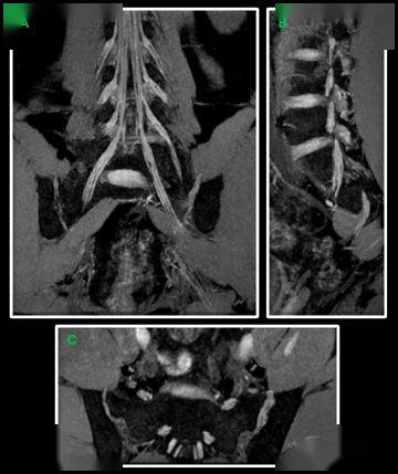 腰骶丛磁共振神经成像
