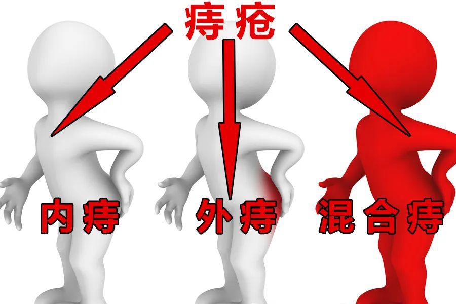 一个穴位帮您远离痔疮之苦