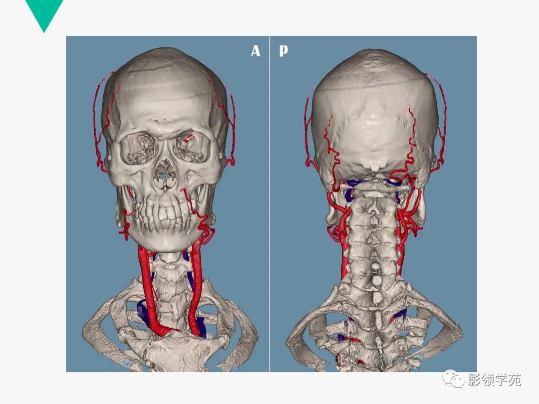解剖 cta头颈血管解剖与分段