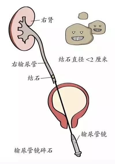 尿路结石位置图片