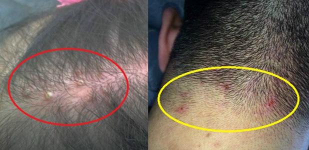 中破坏头皮,让细菌乘机进入头皮,会引起各种炎症,诱发痤疮,毛囊炎等