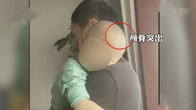 又现大头娃娃多名婴儿喝奶粉致佝偻病网友形同杀人