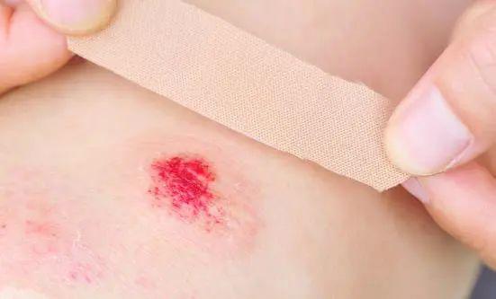 盘点创可贴的6个另类妙用,但在这6种情况下千万别用!