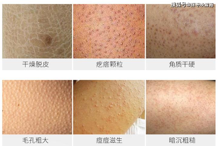 鸡皮肤容易长癣吗(鸡皮肤容易长癣吗女生)