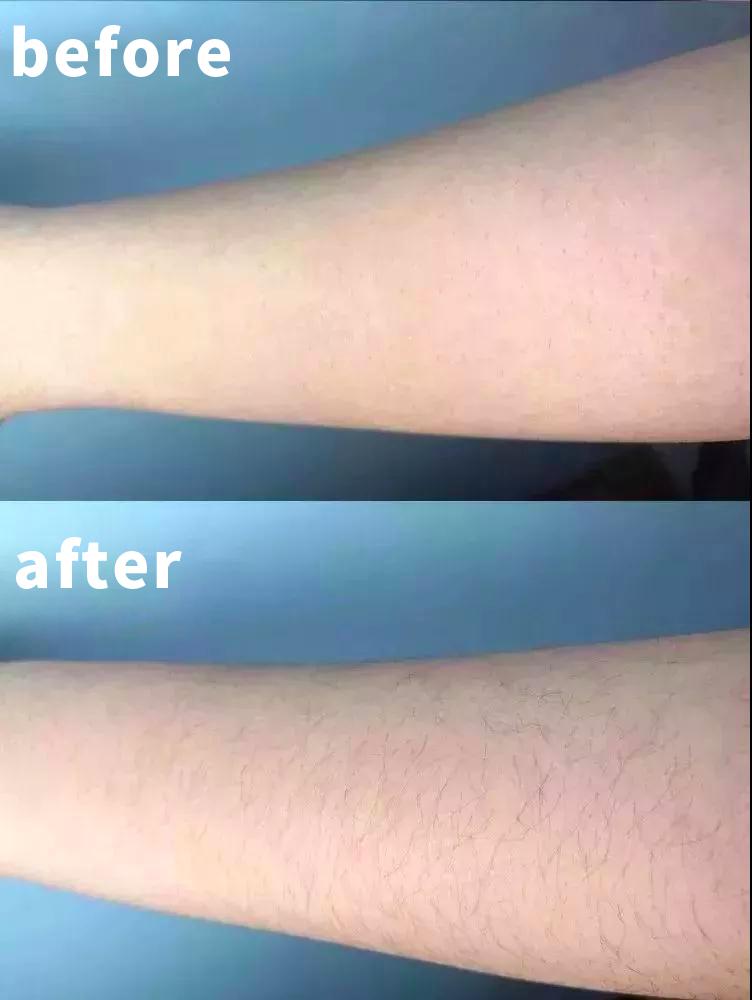 收起你的刮毛刀,脱毛膏,99元德国超冰脱毛,让你告别反复脱毛..._索兰