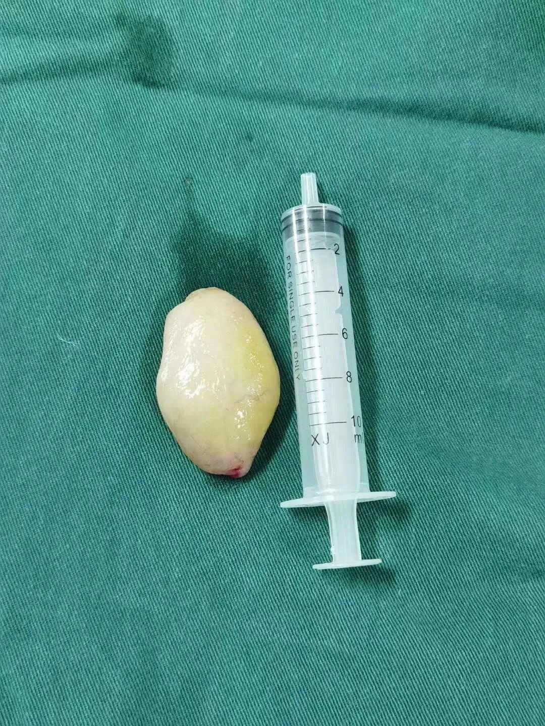 宁夏7岁男孩睡觉打呼噜张嘴呼吸医生从鼻腔里取出鸡蛋大小肿瘤