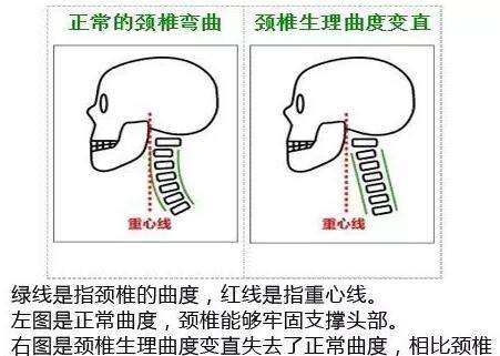 很多人是由於肌肉的疼痛,痙攣,牽拉到骨骼,致使頸椎曲度變直的出現