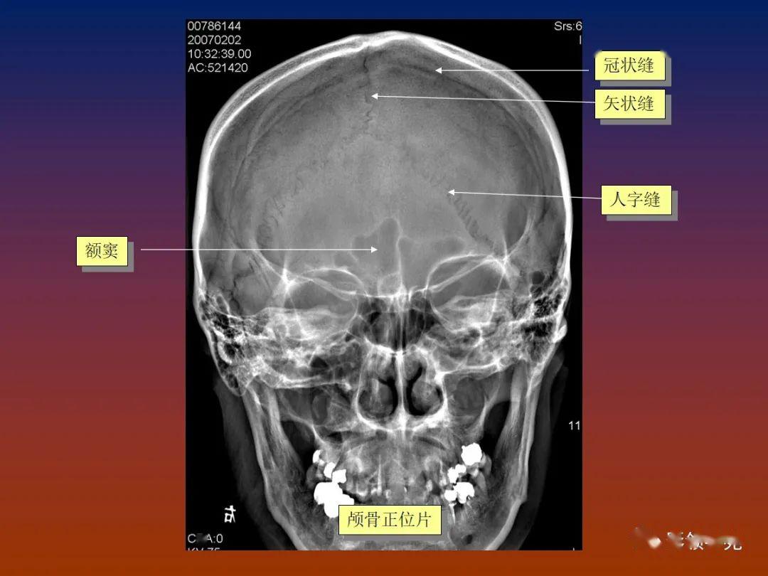 脑血管畸形影像学诊断