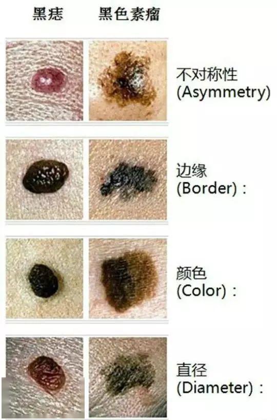重庆大学附属肿瘤医院王东林表示:其实想要分别是色素痣还是黑色素瘤