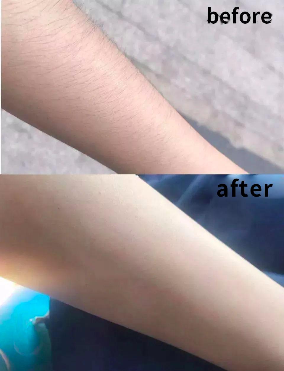 收起你的刮毛刀脱毛膏99元德国超冰脱毛让你告别反复脱毛