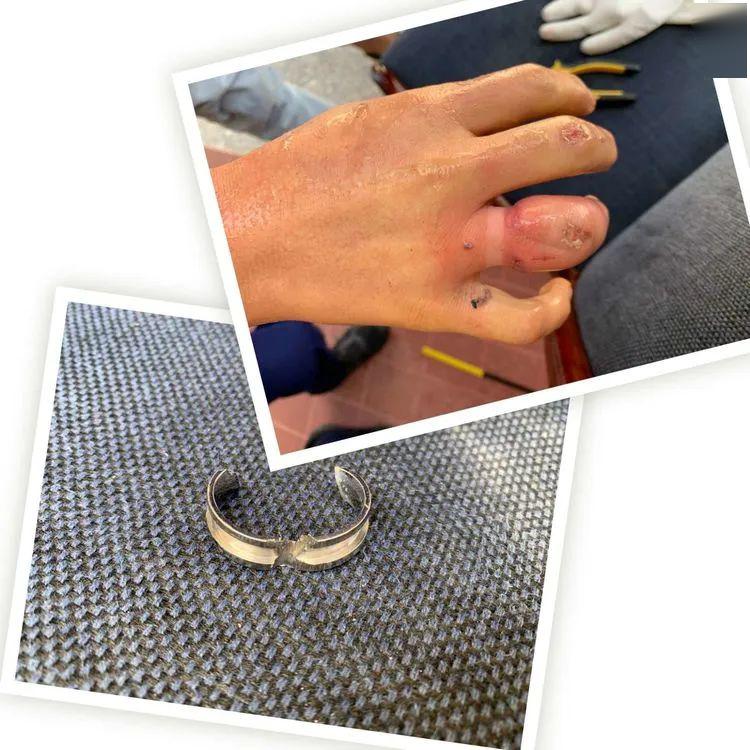 看着都疼戒指卡手上门求助康乐消防成功破戒