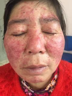 含有激素的药膏或者化妆品,出现一些典型的临床症状:面部皮肤萎缩变薄