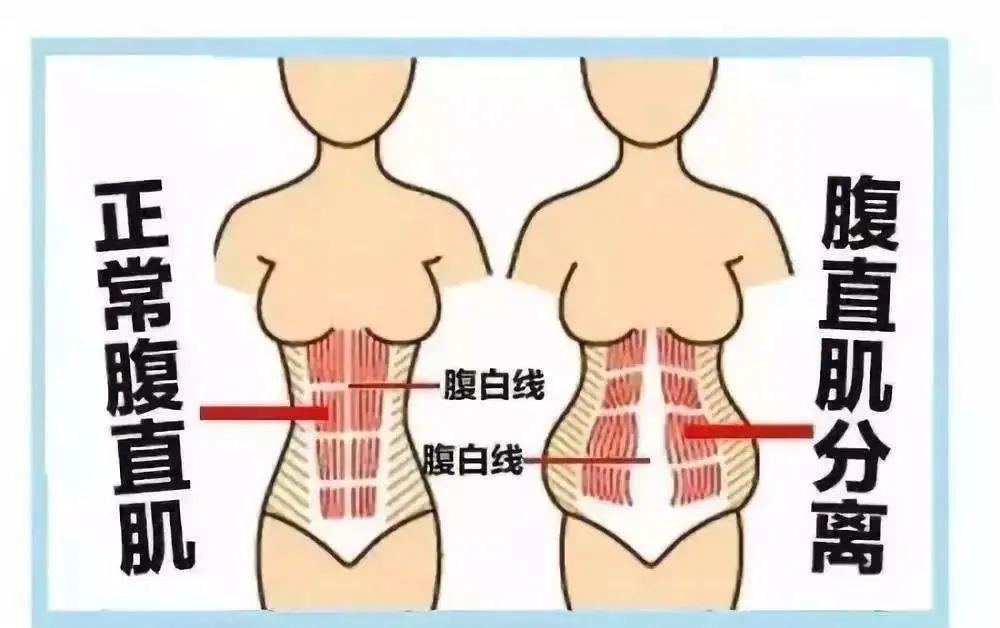 着身体的腰酸背痛,这极有可能是因为妈妈们遭遇了腹直肌分离的情况