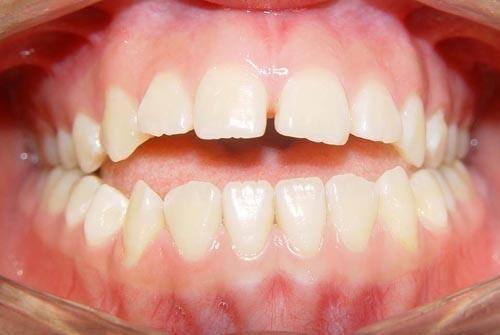 我牙齿整齐为什么医生说非整不可