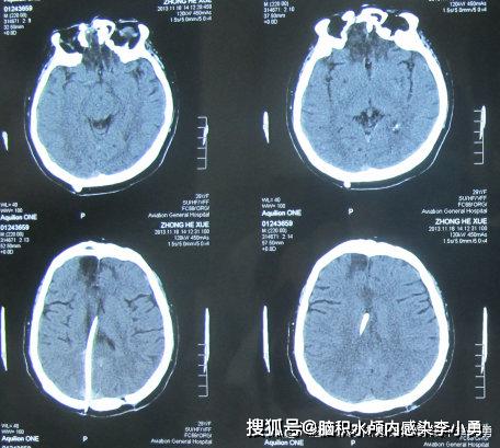 车祸颅脑损伤图片