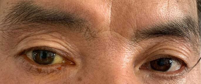 观察10分钟后未见荧光素钠溢出结膜囊术中泪囊造瘘口自市第四医院眼